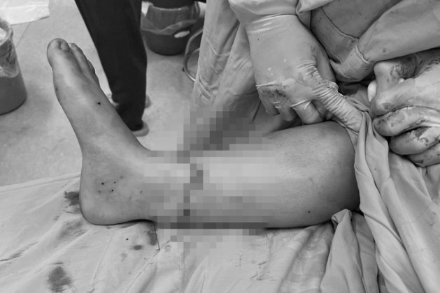 Đắk Lắk: Phẫu thuật nối liền bàn chân bị đứt rời cho bệnh nhân bị tai nạn giao thông