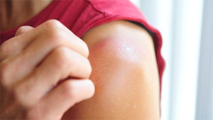 5 mẹo chữa cháy nắng