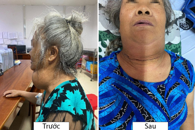 Đắk Lắk: Phẫu thuật thành công cho bệnh nhân bị bướu tuyến giáp khổng lồ