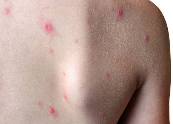 Ghi nhận một trường hợp bệnh đậu mùa khỉ tại Tây Ninh
