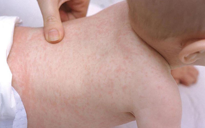 TP. HCM: Ghi nhận 2 trường hợp mắc bệnh sởi trên trẻ chưa được tiêm vắc xin