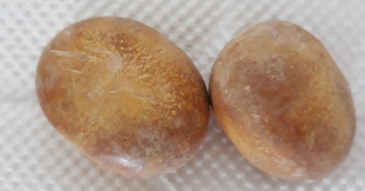 Cần Thơ: Phẫu thuật lấy 2 viên sỏi kích thước lớn trong bàng quang cho cụ ông 83 tuổi