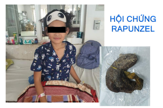 Đắk Lắk: Phẫu thuật cấp cứu thành công cho bệnh nhi mắc hội chứng Rapunzel