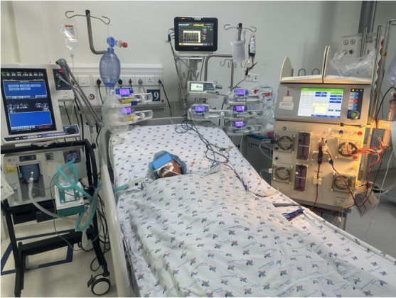 Cứu sống bệnh nhi bị ong đốt nặng tổn thương đa cơ quan