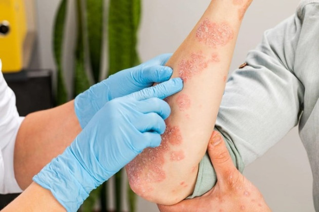 Việt Nam chữa khỏi ca bệnh hiếm về da liễu, cả thế giới chỉ có 10 ca
