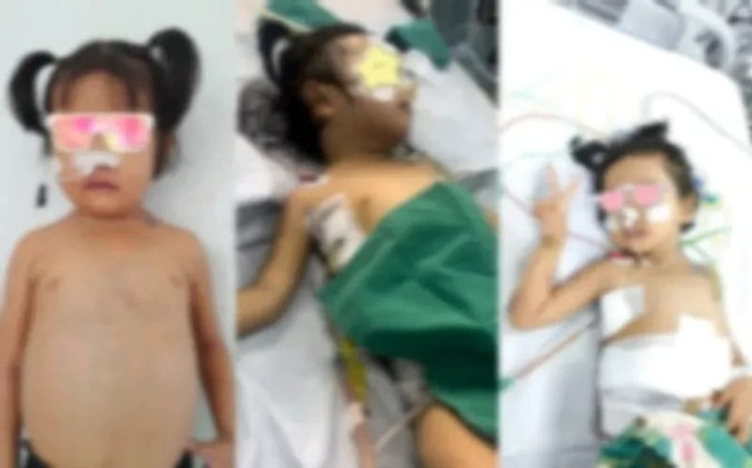 TP. Hồ Chí Minh thực hiện thành công ca ghép gan đặc biệt cho bé gái mắc hội chứng Budd Chiari
