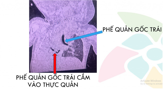 TP. HCM: Cứu sống bệnh nhi dị dạng bẩm sinh phế quản gốc bên phải xuất phát bất thường từ thực quản