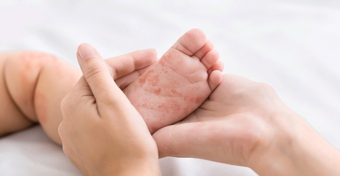 Dấu hiệu khi trẻ bị sởi