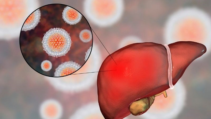 Bệnh viêm gan virus và cách phòng bệnh
