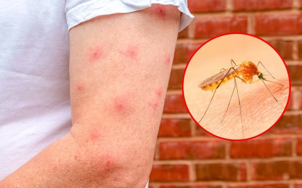 Mẹo đơn giản để giảm ngứa do muỗi đốt tại nhà