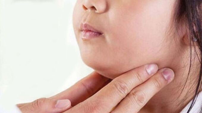 Những điều cần biết về bệnh quai bị