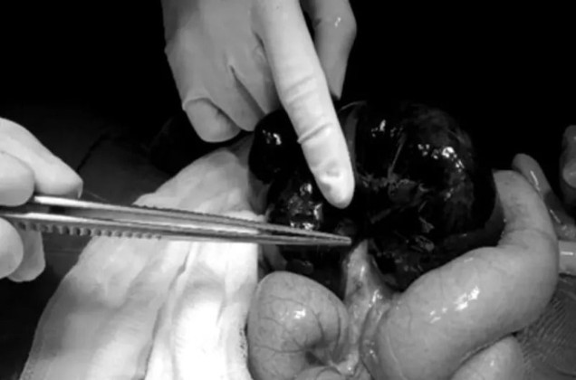 TP. HCM: Bé gái sơ sinh 9 ngày tuổi bị xoắn ruột non với những triệu chứng rất khó phát hiện