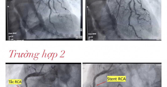Bình Dương: Cứu sống hai bệnh nhân nguy kịch bằng kỹ thuật đặt stent