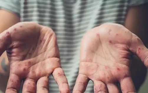 Tăng cường giám sát bệnh đậu mùa khỉ ngay tại cửa khẩu