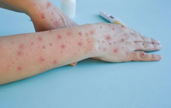 TP. HCM ghi nhận số ca mắc bệnh Mpox cao nhất tại khu vực phía Nam