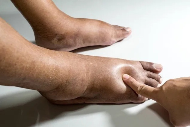 Triệu chứng, nguyên nhân và cách điều trị tuần hoàn kém ở chân