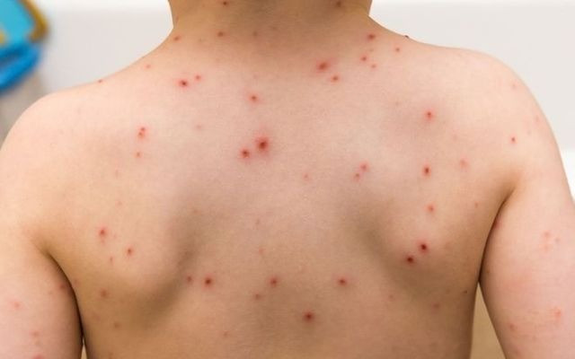 TP. HCM phân công các bệnh viện hỗ trợ chuyên môn kỹ thuật, chỉ đạo tuyến và huấn luyện điều trị về bệnh sởi tại các tỉnh/thành phía Nam