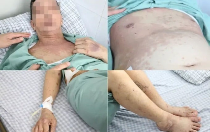 Phú Thọ: Cấp cứu người đàn ông bị dị ứng nổi mẩn toàn thân do tự ý dùng thuốc uống điều trị đau khớp