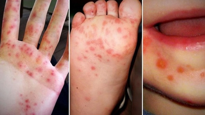 Bệnh tay chân miệng - Không nên chủ quan