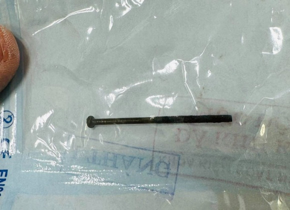 Quảng Ngãi: Gắp thành công đinh vít dài 4 cm trong dạ dày bé trai 3 tuổi