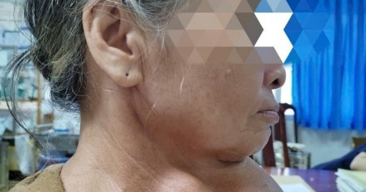 Phẫu thuật cắt bỏ khối bướu giáp khổng lồ cho nữ bệnh nhân 64 tuổi