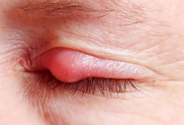 Tìm hiểu về bệnh đau mắt hột