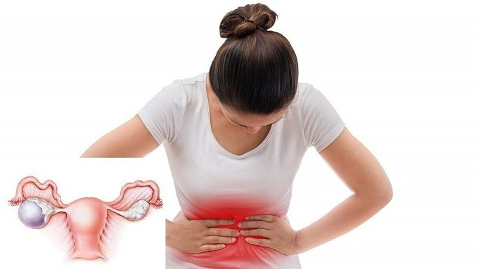 Những lưu ý đối với phụ nữ có hội chứng buồng trứng đa nang