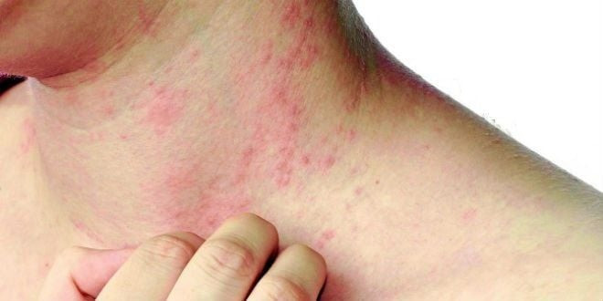 Biểu hiện trên da có thể là dấu hiệu của tiền tiểu đường