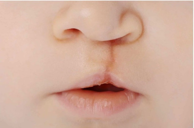 TP. HCM: Hỗ trợ kinh phí điều trị và xây dựng, phát triển Trung tâm điều trị toàn diện cho trẻ khe hở môi - vòm miệng