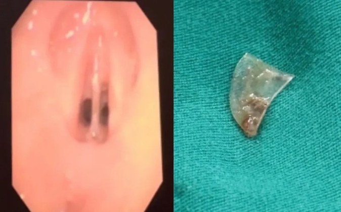 Lấy dị vật bỏ quên khá lâu và kẹt lại giữa hai dây thanh của trẻ
