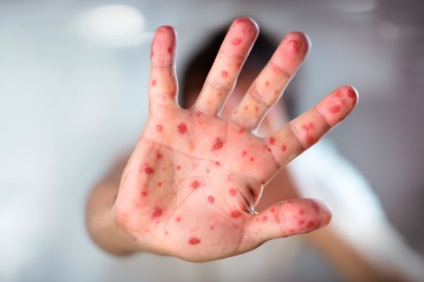 An Giang tăng cường công tác phòng, chống bệnh sởi