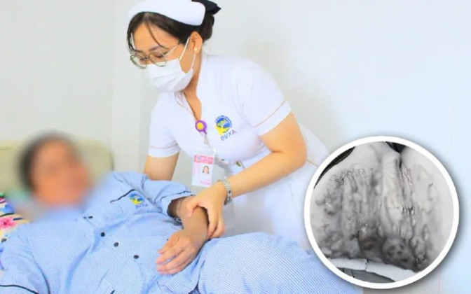Long An: Cấp cứu bệnh nhân bị bỏng khi đi giác hơi