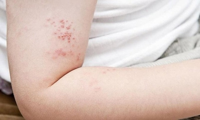 Tìm hiểu về bệnh zona thần kinh