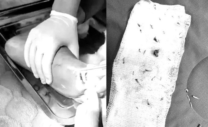 Phú Thọ: Bệnh nhân 85 tuổi có ổ giòi trong vết thương bệnh nhân