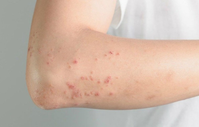 Các biến chứng của bệnh sởi và cách phòng tránh