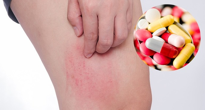 Dị ứng thuốc khó kiểm soát