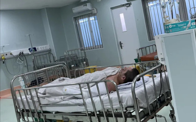Phẫu thuật cấp cứu bệnh nhi 12 tuổi bị dập nát bàn tay do pháo nổ