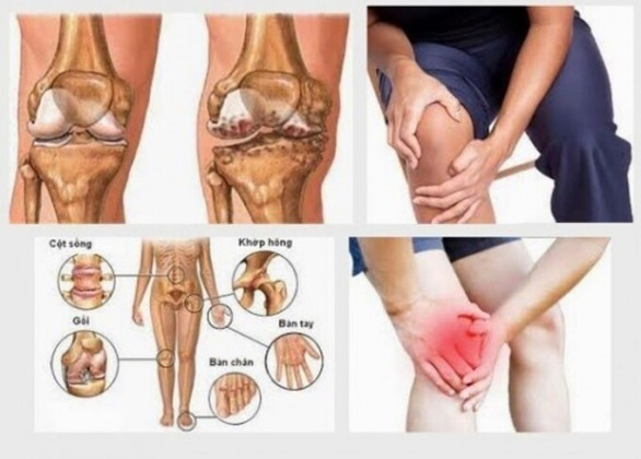 Bệnh thấp khớp vào mùa lạnh và cách phòng ngừa
