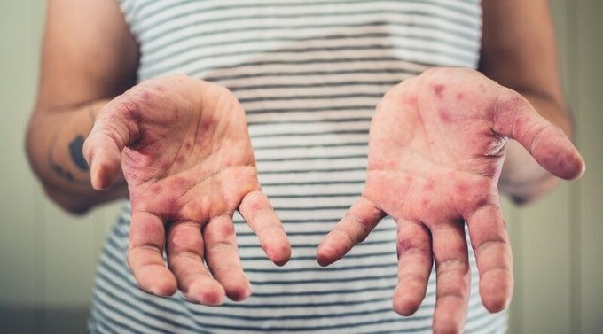 Bệnh sởi và cách chăm sóc người mắc sởi tại nhà