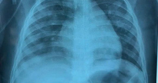 Điều trị bệnh nhi phổi đông đặc vì mắc cúm A và sởi