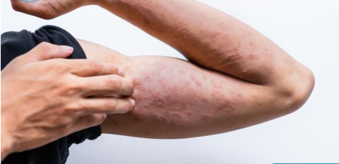 Đề phòng bệnh da liễu khi thời tiết nồm ẩm kéo dài