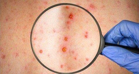 Lâm Đồng: Đảm bảo công tác phòng, chống bệnh sởi trên địa bàn tỉnh