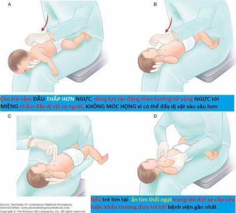 Hướng dẫn cách thực hiện thủ thuật Heimlich giúp cứu người bị hóc dị vật