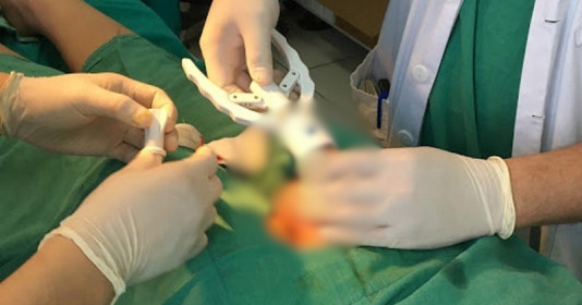 Cắt bao quy đầu "chui" - Hậu quả khôn lường cho sức khỏe nam giới