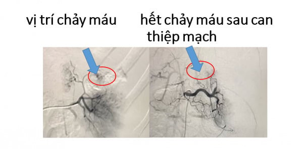 Bé gái 5 tuổi bị chấn thương vỡ lách độ IV do tai nạn giao thông