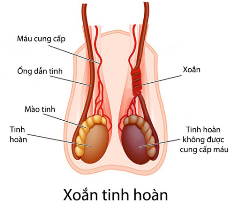 Cảnh giác với xoắn tinh hoàn ở trẻ em