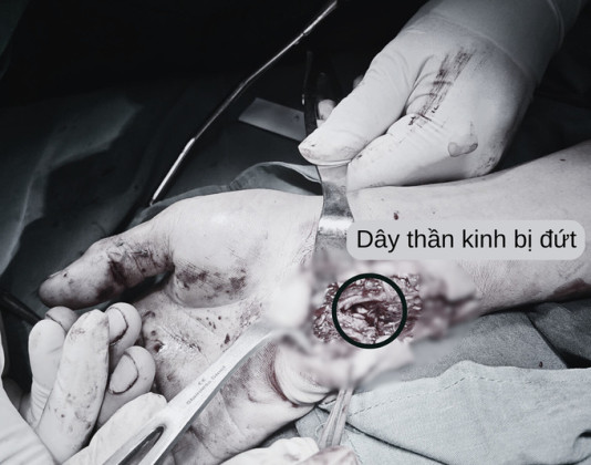 Tức giận, nam thanh niên đập tay vào kính, đứt gân cơ và bó mạch thần kinh cổ tay