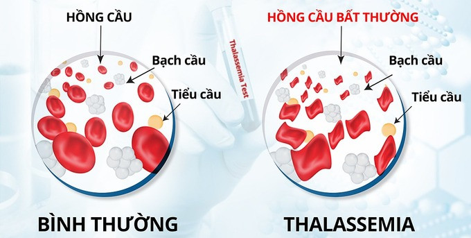 Hưởng ứng Ngày Thalassemia Thế giới 8/5: Chung tay vì sức khỏe cộng đồng