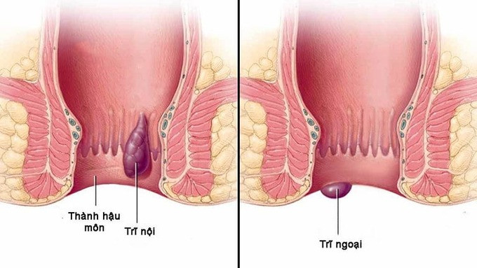 Hiểu đúng về bệnh trĩ để phòng ngừa hiệu quả