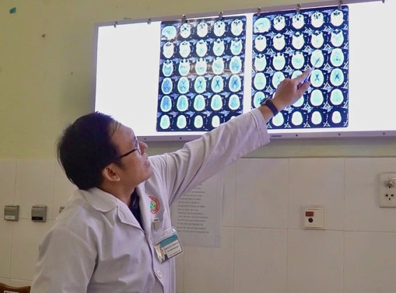 Bệnh viện Đa khoa Cà Mau can thiệp thành công ca phình mạch não